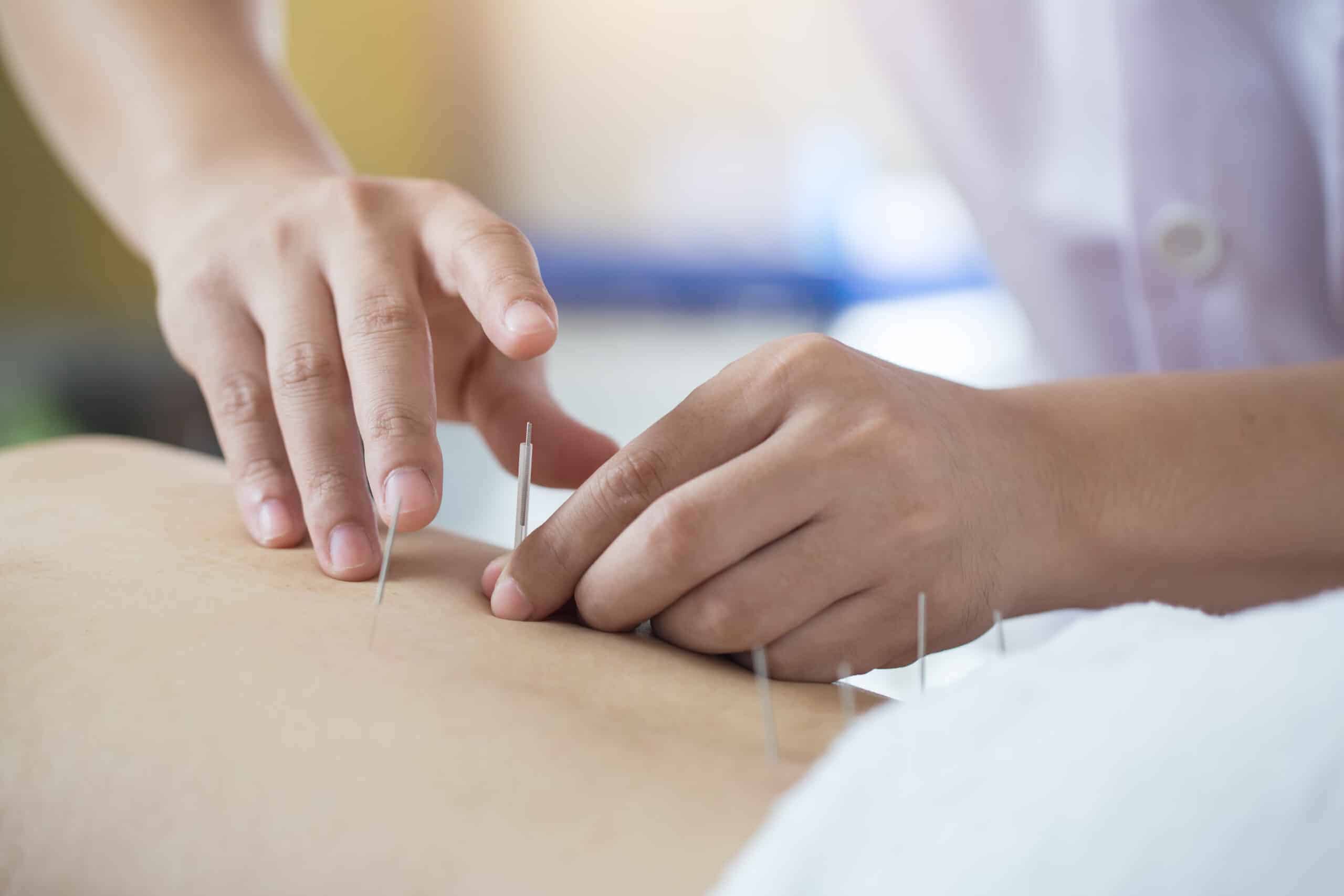 Traditional Chinese Medicine Treatment - Acupuncture